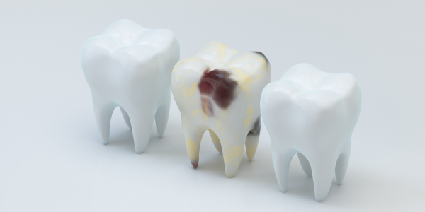 Caries Senlis